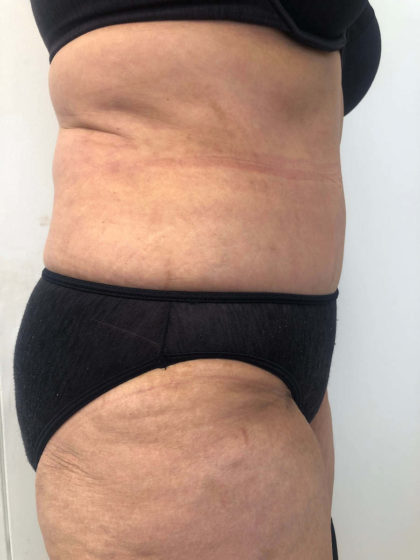 Tummy Tuck Before & After Patient #6634