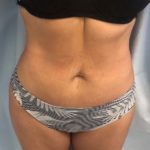 Tummy Tuck Before & After Patient #6645