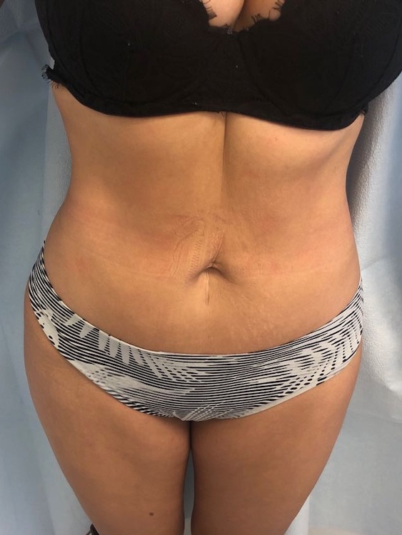 Tummy Tuck Before & After Patient #6645