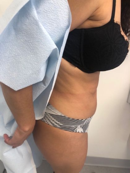 Tummy Tuck Before & After Patient #6645