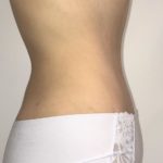 Tummy Tuck Before & After Patient #6645