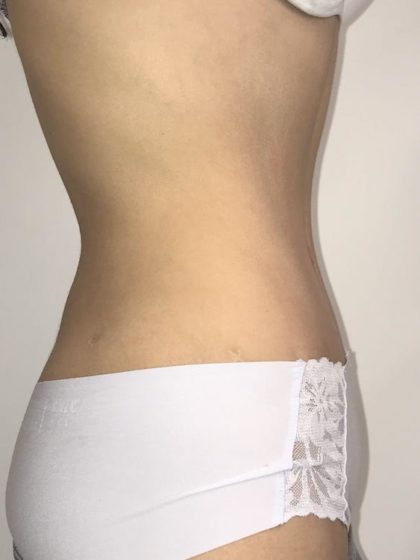 Tummy Tuck Before & After Patient #6645