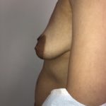 Breast Reconstruction Before & After Patient #6654
