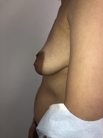 Breast Reconstruction Before & After Patient #6654