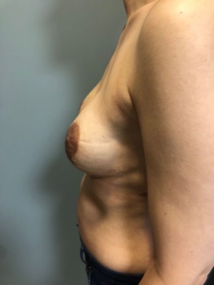 Breast Reconstruction Before & After Patient #6654