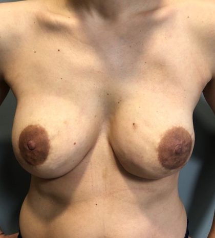 Breast Reconstruction Before & After Patient #6654