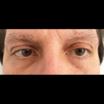 Eyelid Surgery Before & After Patient #6689