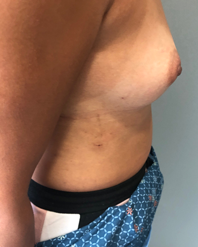 Breast Reconstruction Before & After Patient #6870