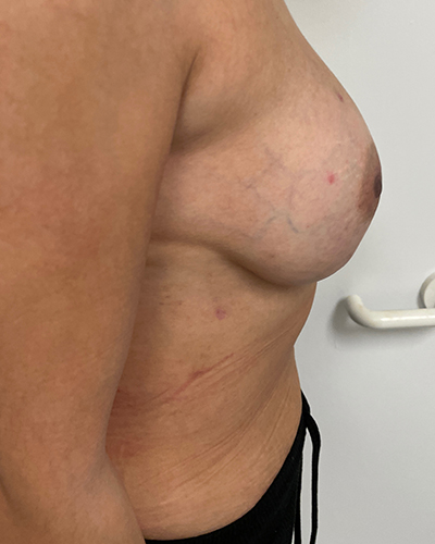 Breast Reconstruction Before & After Patient #6870