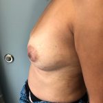 Breast Reconstruction Before & After Patient #6870