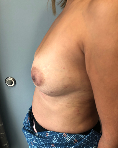 Breast Reconstruction Before & After Patient #6870