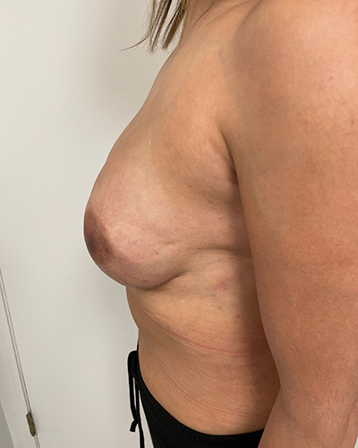 Breast Reconstruction Before & After Patient #6870