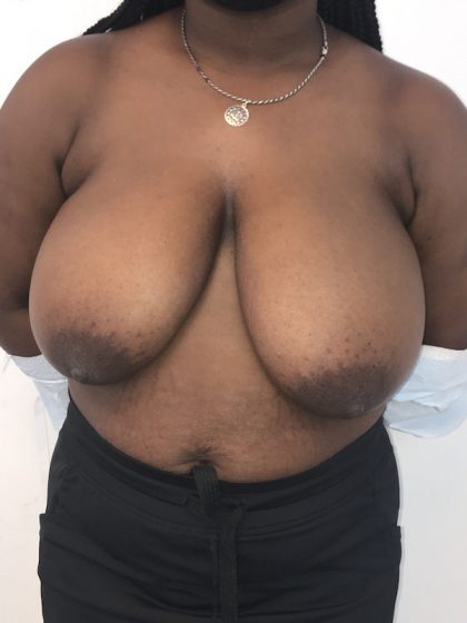 Breast Reduction Before & After Patient #6877
