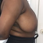 Breast Reduction Before & After Patient #6877