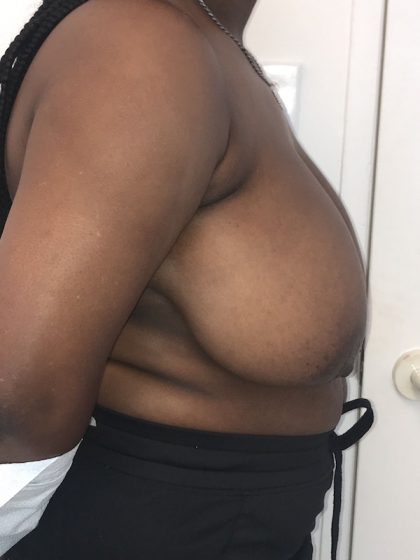 Breast Reduction Before & After Patient #6877