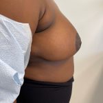 Breast Reduction Before & After Patient #6877