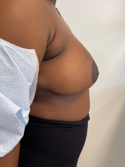 Breast Reduction Before & After Patient #6877
