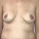 Breast Augmentation Before & After Patient #6900