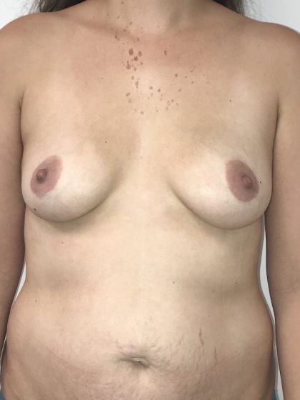 Breast Augmentation Before & After Patient #6900