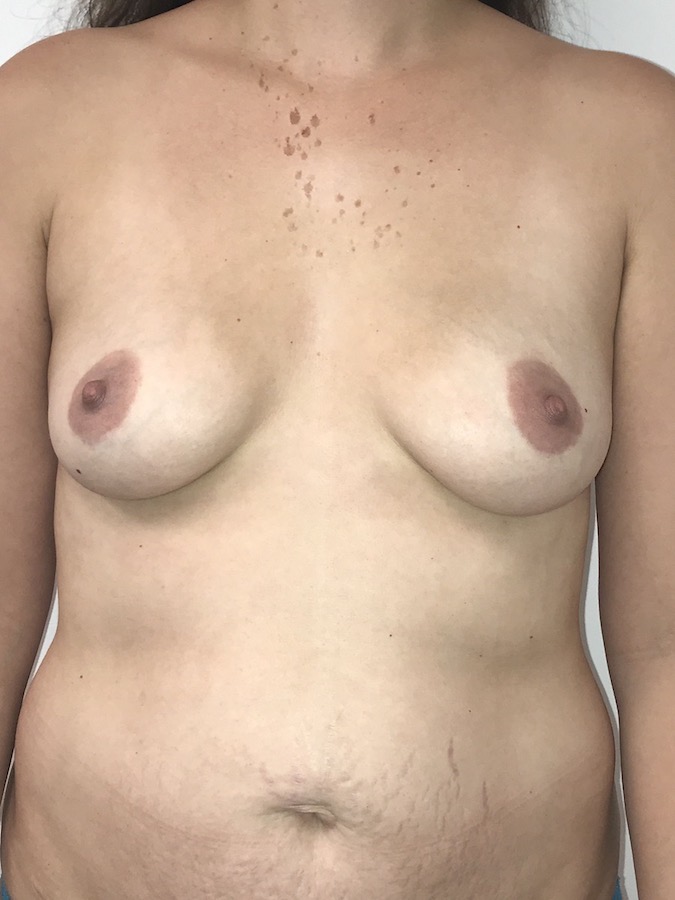 Breast Augmentation Before & After Patient #6900