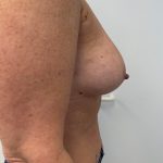 Breast Augmentation Before & After Patient #6903