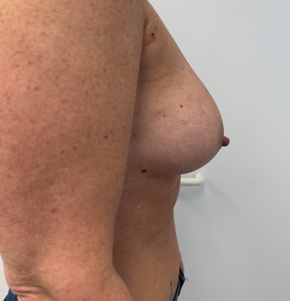 Breast Augmentation Before & After Patient #6903