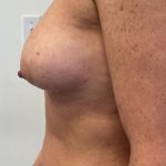 Breast Augmentation Before & After Patient #6903