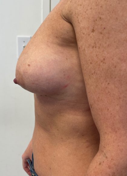 Breast Augmentation Before & After Patient #6903