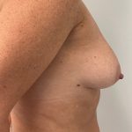 Breast Augmentation Before & After Patient #6903