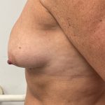 Breast Augmentation Before & After Patient #6903