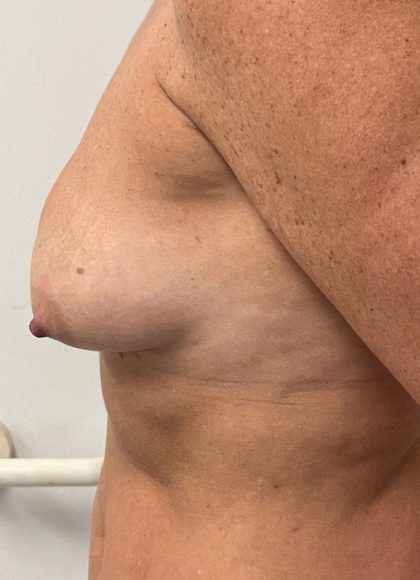 Breast Augmentation Before & After Patient #6903