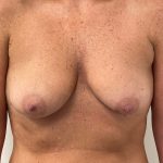 Breast Augmentation Before & After Patient #6903