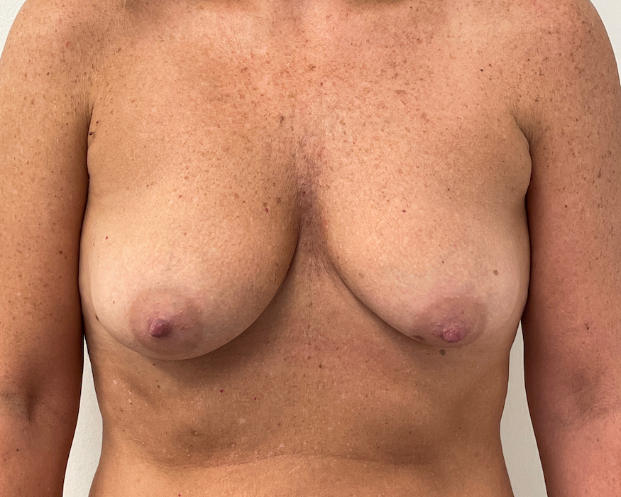 Breast Augmentation Before & After Patient #6903