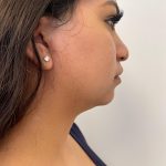 Facetite Before & After Patient #6971