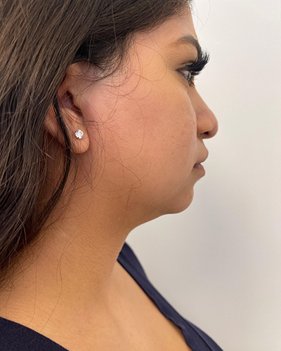 Facetite Before & After Patient #6971