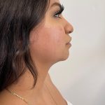 Facetite Before & After Patient #6971