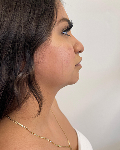 Facetite Before & After Patient #6971