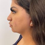 Facetite Before & After Patient #6971
