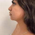 Facetite Before & After Patient #6971
