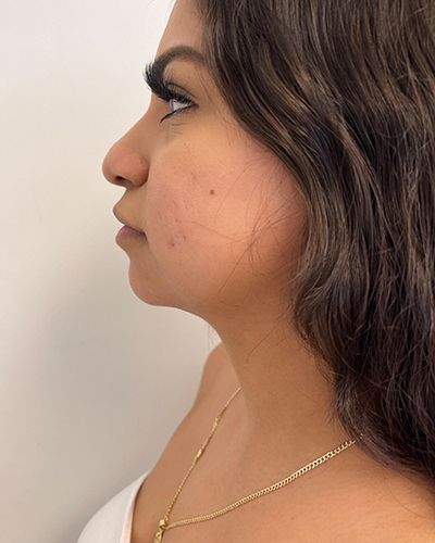 Facetite Before & After Patient #6971