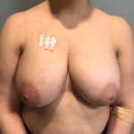 Breast Reconstruction Before & After Patient #6976