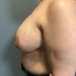 Breast Reconstruction Before & After Patient #6976