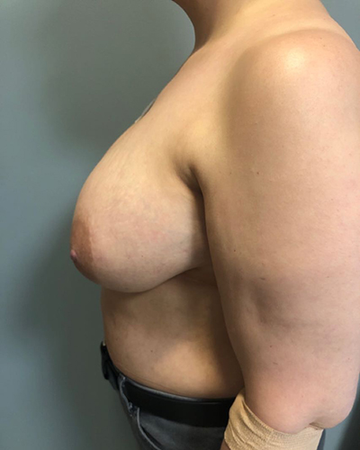 Breast Reconstruction Before & After Patient #6976