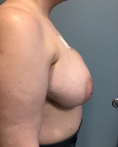 Breast Reconstruction Before & After Patient #6976