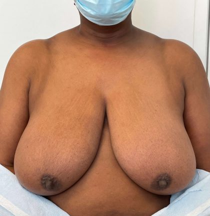 Breast Reduction Before & After Patient #7031
