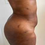 Tummy Tuck Before & After Patient #7065