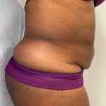 Tummy Tuck Before & After Patient #7065