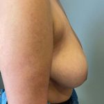 Breast Augmentation Before & After Patient #7162
