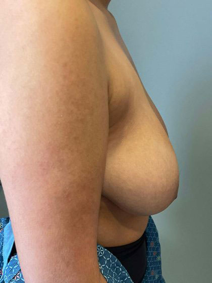 Breast Augmentation Before & After Patient #7162