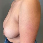 Breast Augmentation Before & After Patient #7162